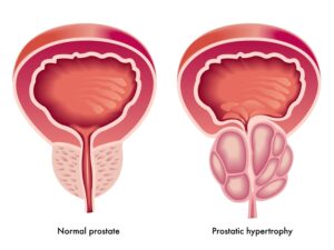 Hiperplasia prostática benigna